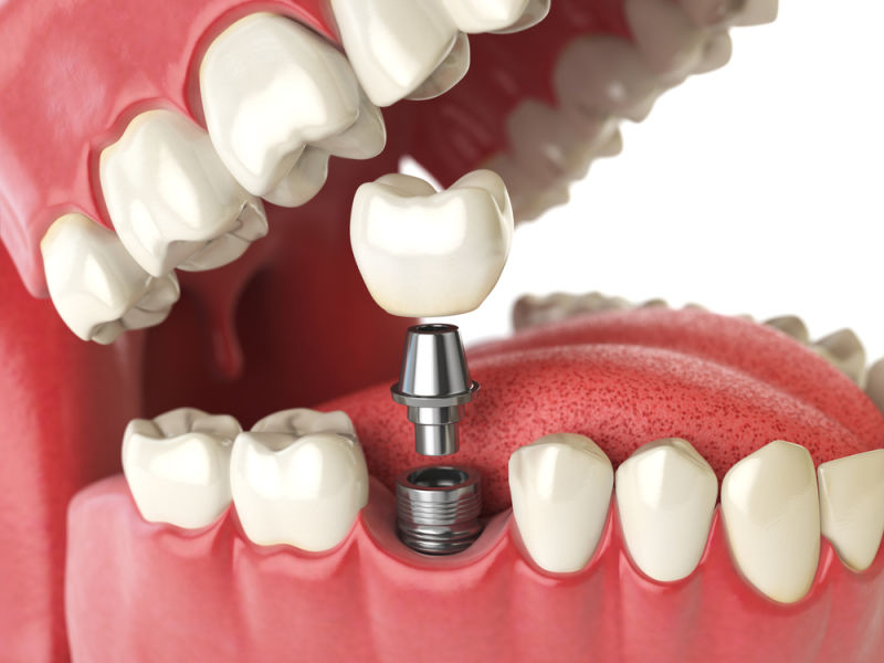 dental implant Harrisonburg